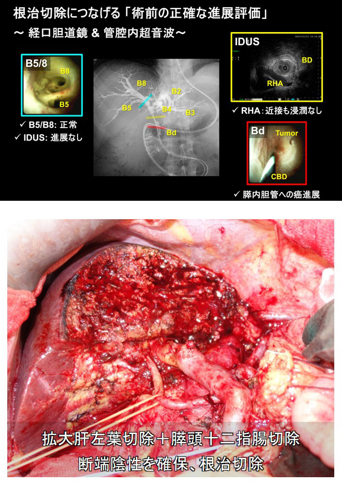 肝門部領域胆管癌に対する拡大手術